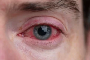 Can Dry Eyes Cause Blindness