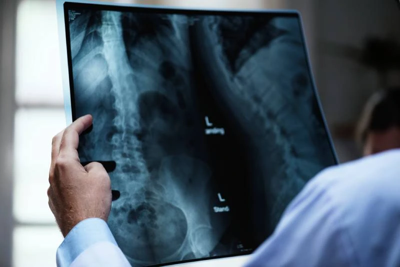 Spinal X-ray analysis for scoliosis diagnosis by orthopedic specialists at Magnet Health NY, 741 E 233rd St, Bronx, NY 10466