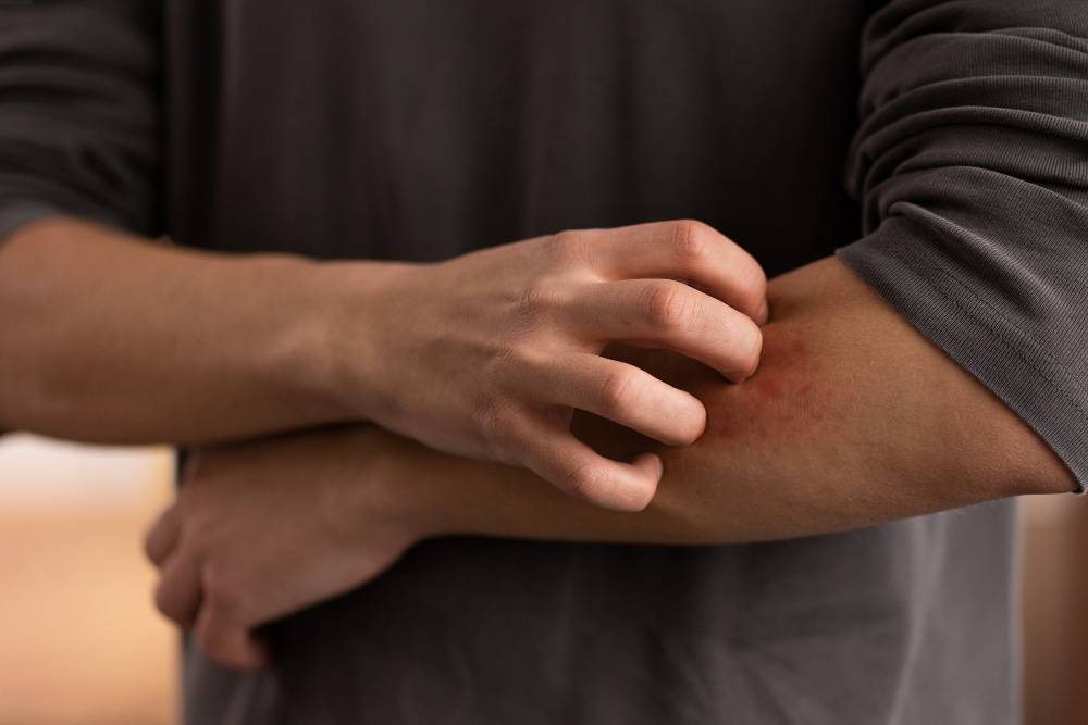 Itchy Skin