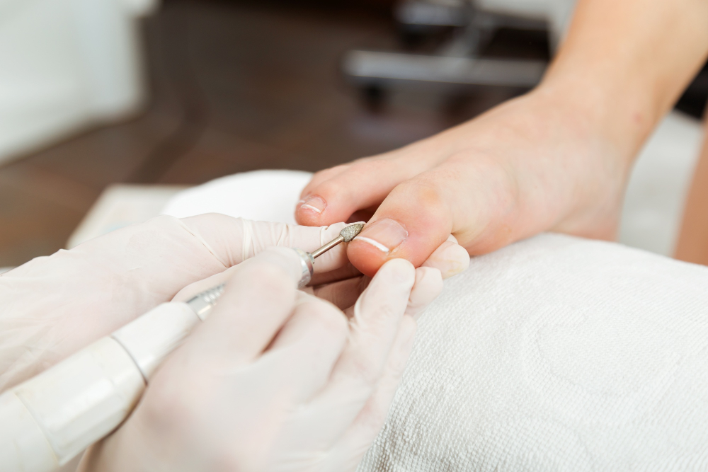 Podiatrist Remove Calluses