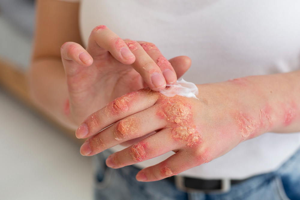Bacterial vs Fungal Skin Infections